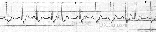 Psvt Ecg Clinical Practice Guidelines Supraventricular Tachycardia Svt Learn About